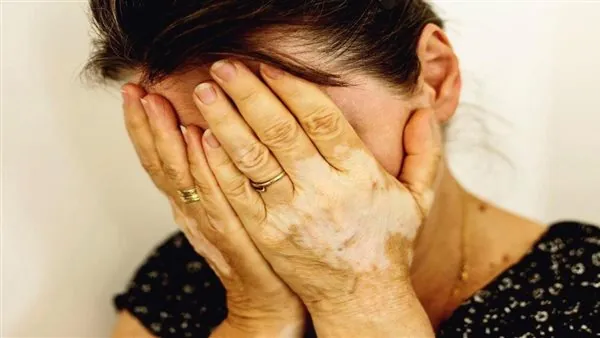 Woman covering her face, with pale patches on her hands