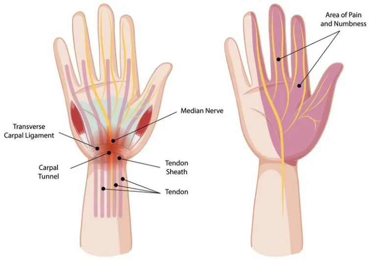 Diagram of the hand showing the median nerve and carpal tunnel