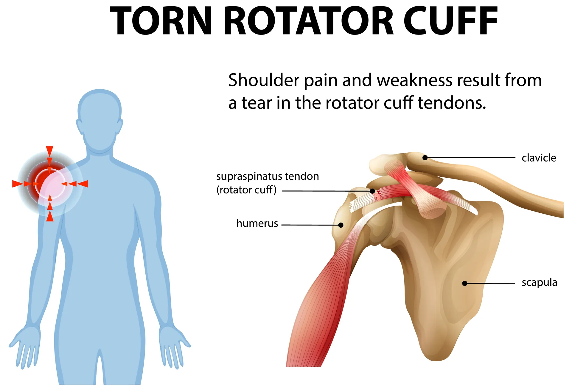 Diagram of a torn rotator cuff tendon and shoulder anatomy